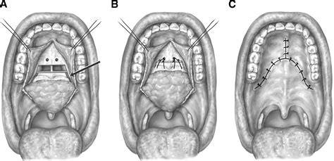 diagramma della Barbed Repositioning Pharyngoplasty