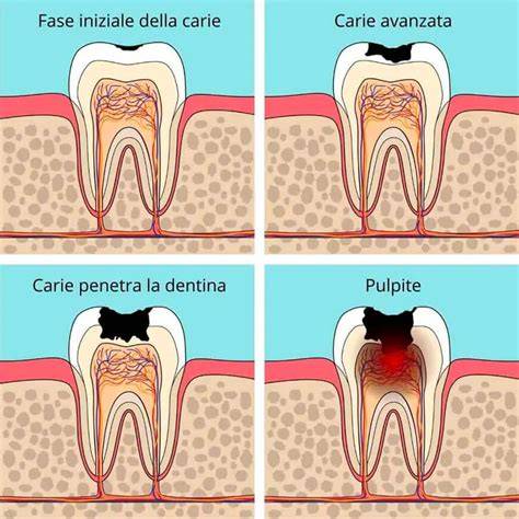 grafico cause dolore denti senza carie