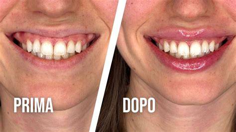 Фото del prima e dopo del sorriso