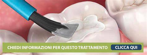 Video dimostrativo di trattamento odontoiatrico
