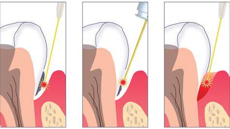Video esemplificativo di laser per parodontite