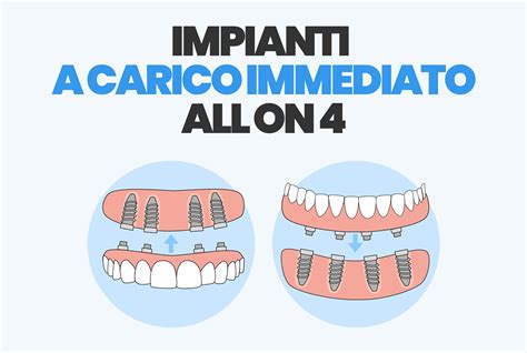 schema di implantologia a carico immediato