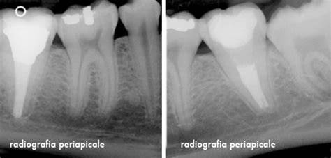 Immagine: radiografie endodontiche e apice radice