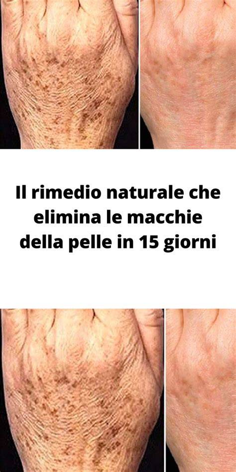 rimedio macchie pelle e tessuti infografica