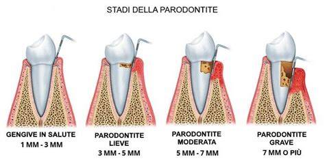 scheda riassuntiva parodontite stadi