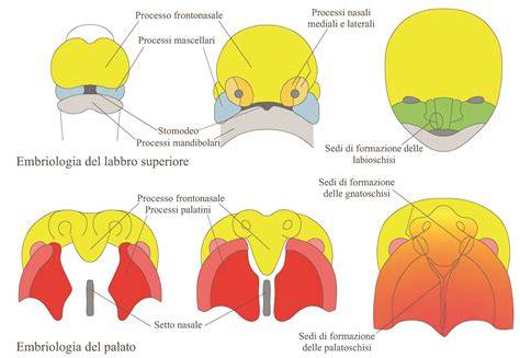 schema dei percorsi chirurgici della labiopalatoschisi