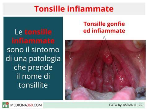 rappresentazione anatomica dell'orofaringe e tonsille