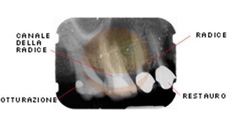 disposizione raggi radiografia endorale diagramma