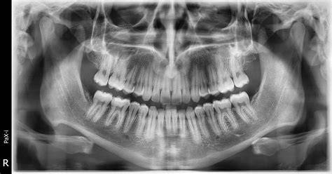 panoramica radiografia ortopantomografia