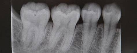 posizionamento radiografia endorale diagramma