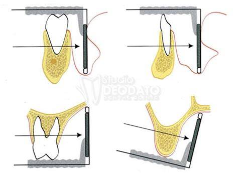 tecnica parallela radiografie odontoiatria