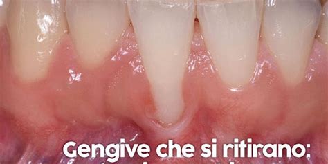 gengive che si ritirano infografica