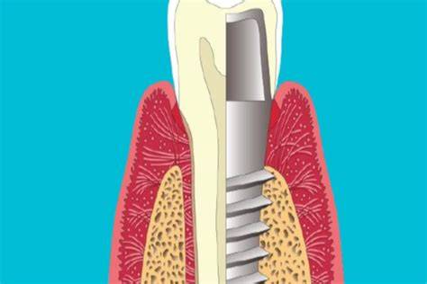 schema osteointegrazione
