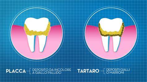 grafico placca e tartaro