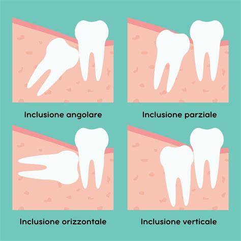 raffigurazione di denti del giudizio inclusi