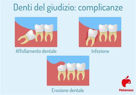 grafico su sintomi del dente del giudizio
