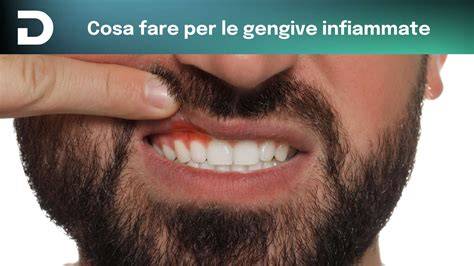 trattamenti gengive infiammate
