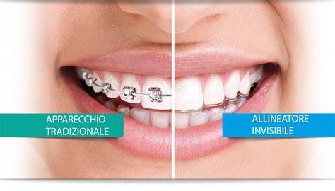 distribuzione di allineatori Invisalign