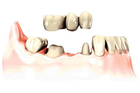 Protesi singola, ponte fisso, protesi completa