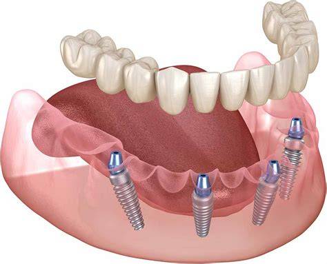 Impianto-retentore per dentiera