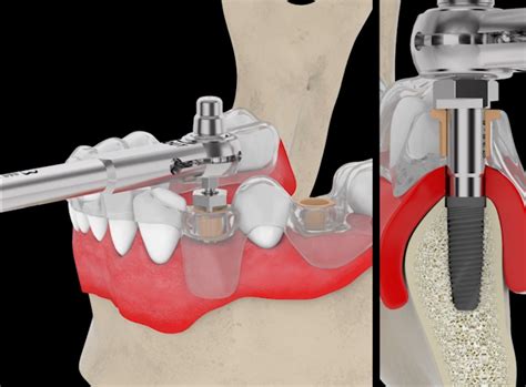 Chirurgia implantare descrizione