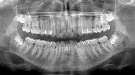 panoramica dentale: arcate e ossa mascellari
