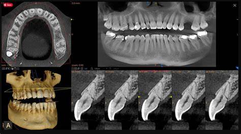 Imaging CBCT 3D e posizione nervo mandibolare