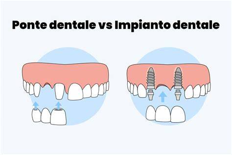 diagramma differenze ponte tradizionale vs ponte su impianti