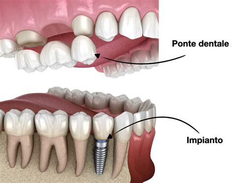 impianti dentali e ponti correlati