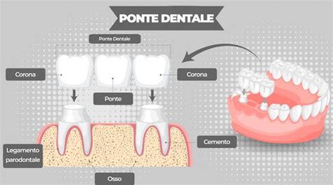 igiene e cura di ponte dentale