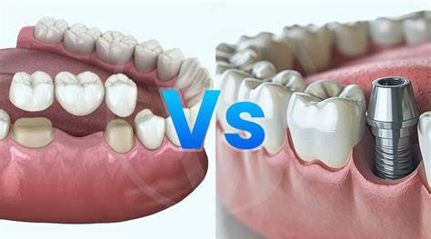 tabella confronto ponte vs implant
