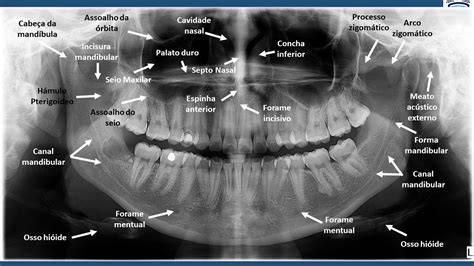 radiografia panoramica per ponti