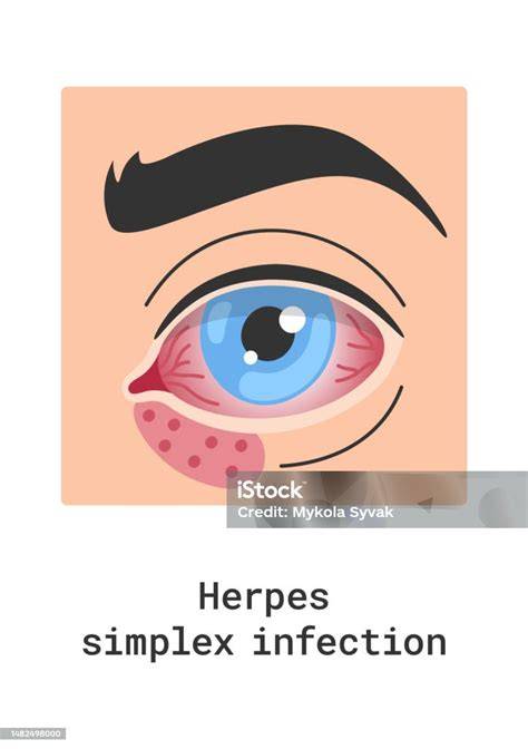 Immagine: ciclo di infezione da herpes simplex