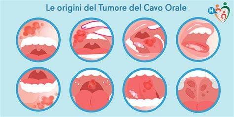 trattamento tumore cavo orale
