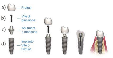 schema di implantologia zirconia