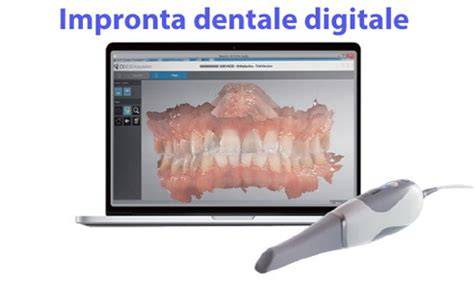 scheda comparativa tra impronta tradizionale e scanner intraorale