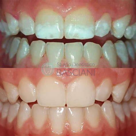macchie bianche sui denti infographic