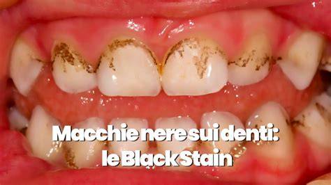 black stains macchie nere sui denti panorama