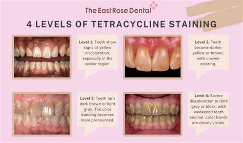gray stains teeth antibiotic tetracycline