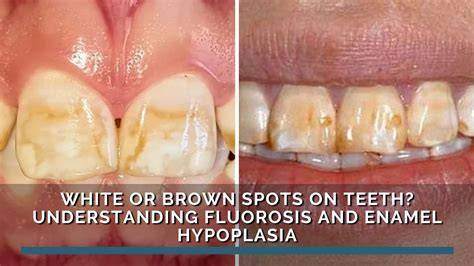 brown stains tartar fluorosis