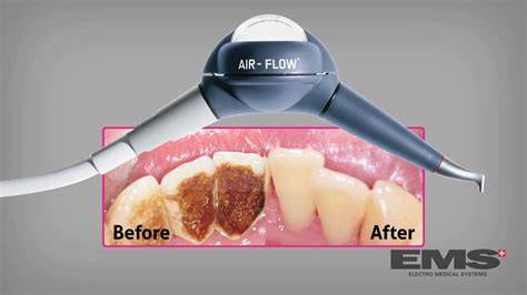 air flow dental cleaning illustration