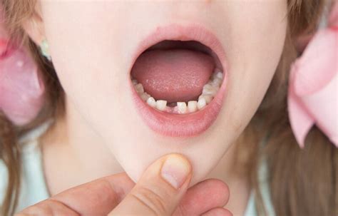 trattamenti per papilite lingual transitoria