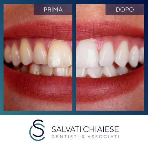 infografica sui processi di sbiancamento dentale