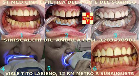 chart di tempi di sbiancamento