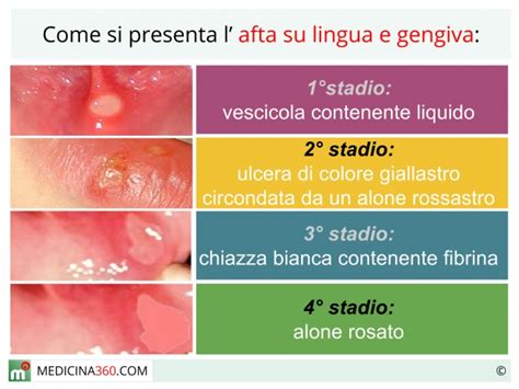 formicolio bocca gengive lingua infografica