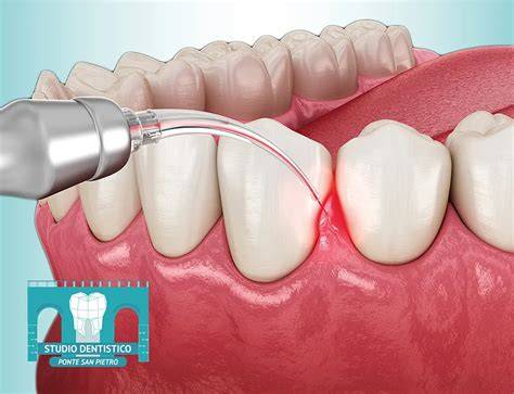 illustrazione laser gengive